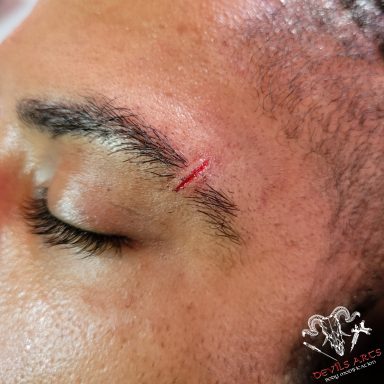 Mini-Schmiss als Cutting / Scarification an der Augenbraue von DEVILS-ARTS Emmelshausen